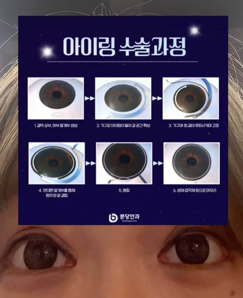 현재 여론 살벌한 눈동자 성형수술.JPG (충격주의)